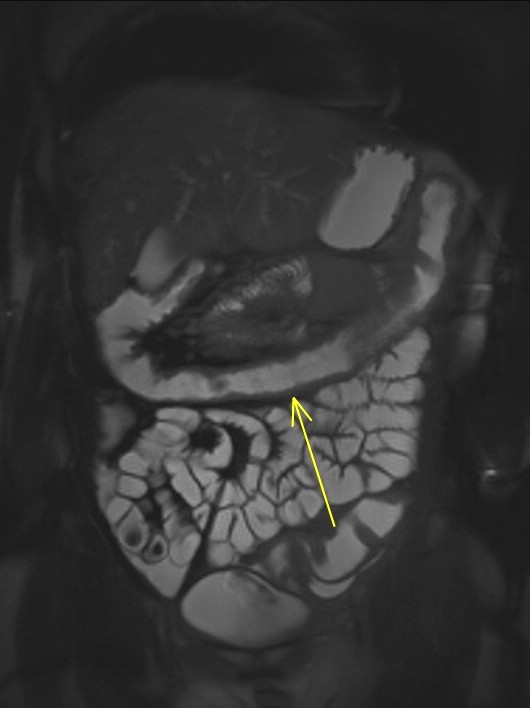 Figure 2 for case Enteropathic arthropathy